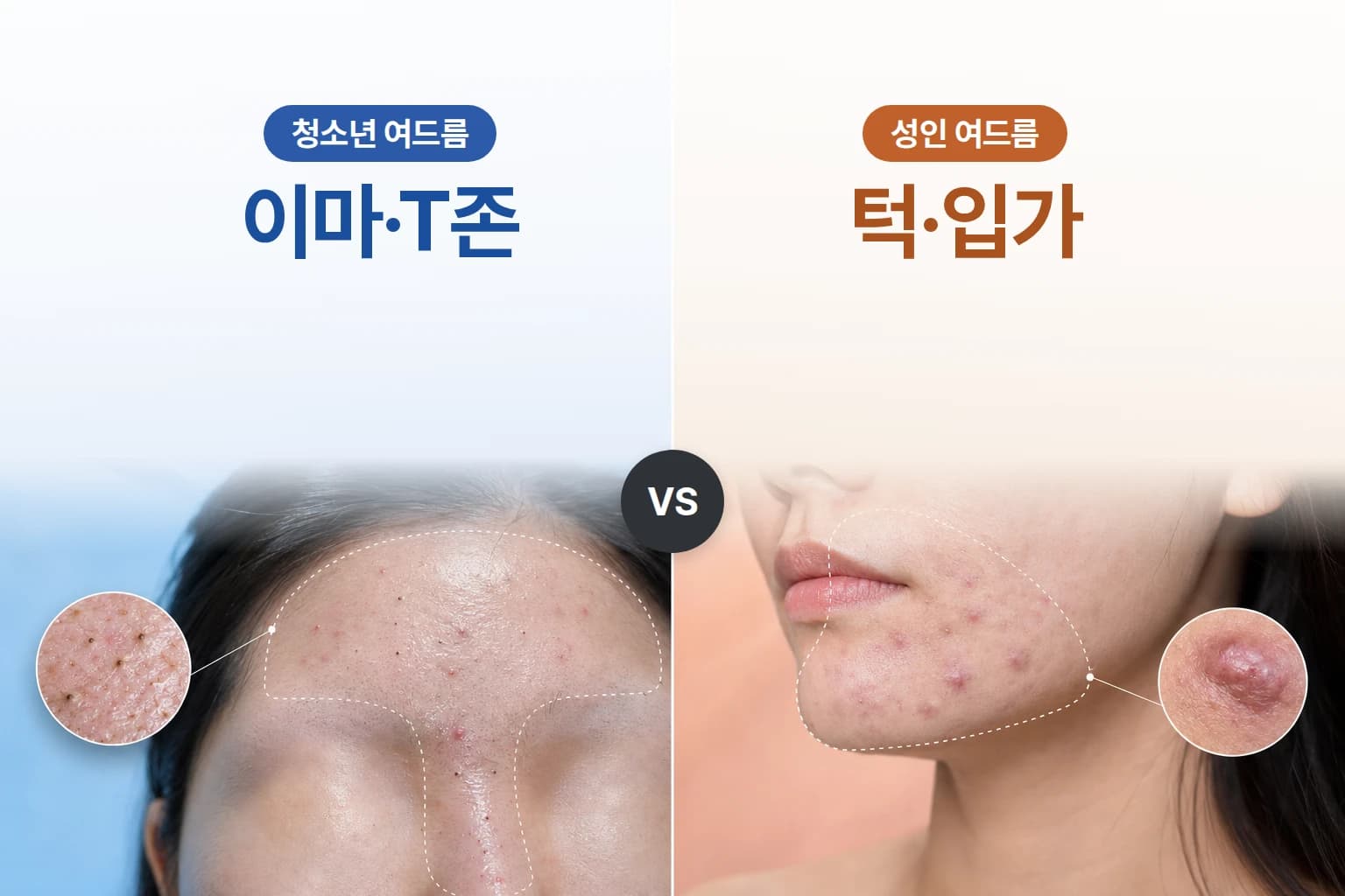 성인과 청소년의 여드름 원인 차이를 발생 부위와 함께 비교한 피부 일러스트