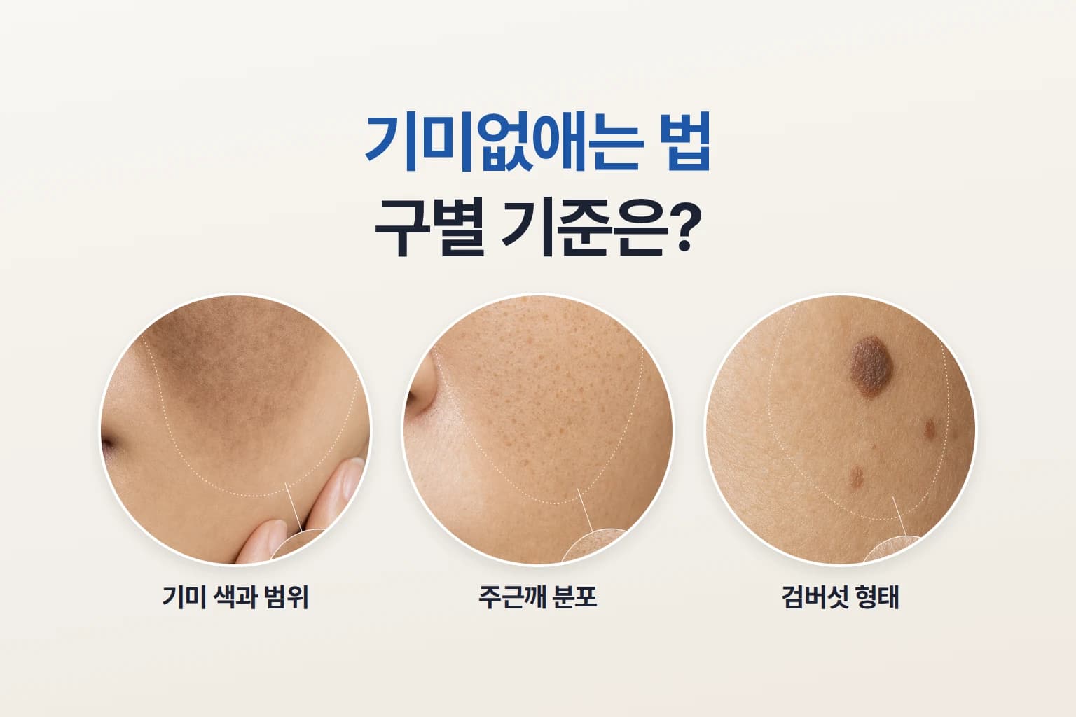 기미·주근깨·검버섯의 색과 분포 형태 구별 기준을 보여주는 썸네일